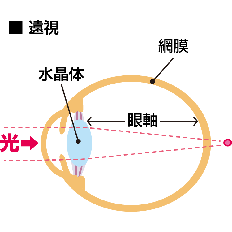 遠視症状, 遠視が進む原因 : 遠視（エンシ）について【病名検索ホスピタ】 – UTSJ