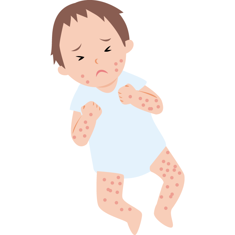 水ぼうそう 水痘 の原因 症状 疾患ナビ 健康サイト