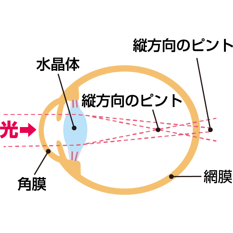 乱視の原因 症状・疾患ナビ | 健康サイト