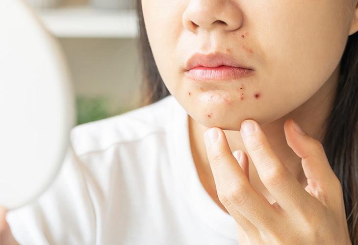 あご(顎)ニキビの原因と対策を紹介！ 繰り返すニキビはしっかりケアしよう