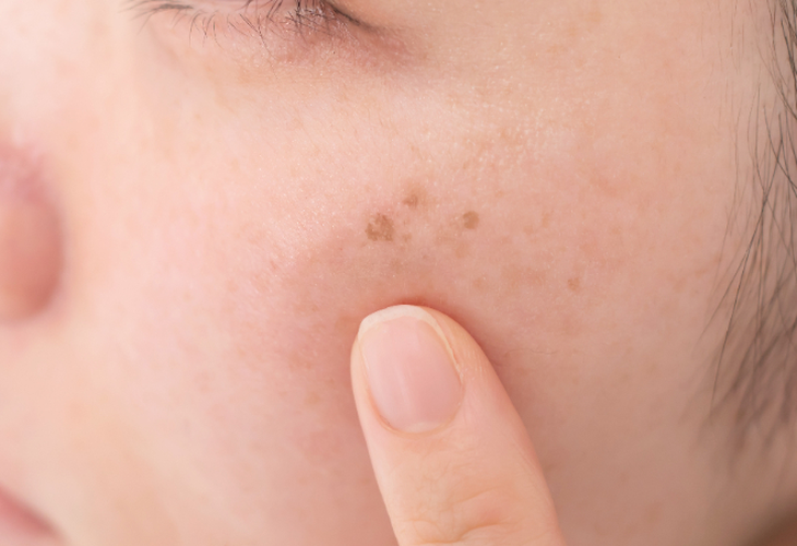 色素沈着とは？しみや黒ずみ、くすみには体の内側と外側から対策しよう！