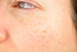 メラニンとは？しみができる仕組みや色素沈着を緩和する方法について解説