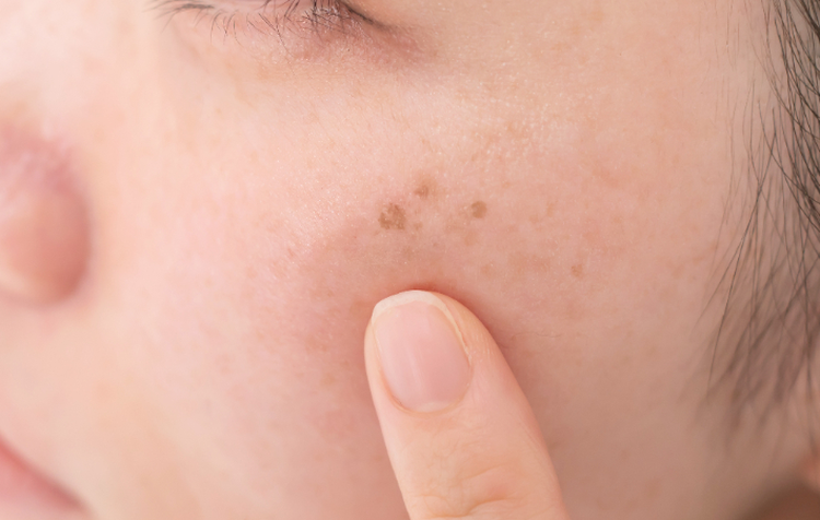 色素沈着とは？しみや黒ずみ、くすみには体の内側と外側から対策しよう！