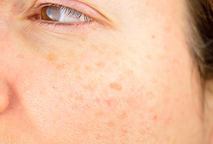 メラニンとは？しみができる仕組みや色素沈着を緩和する方法について解説