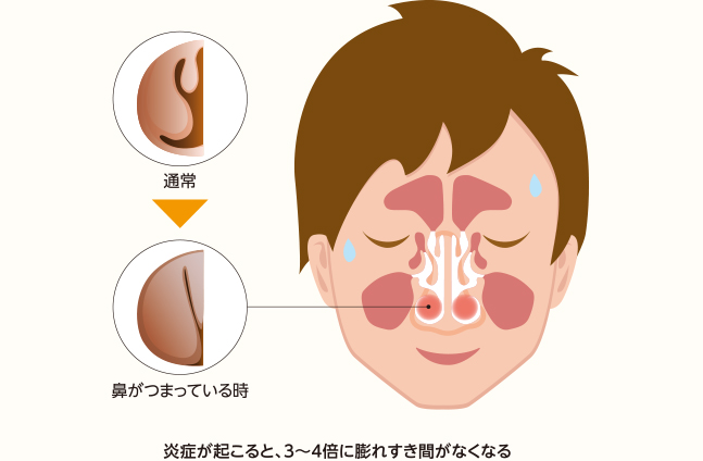 鼻の炎症