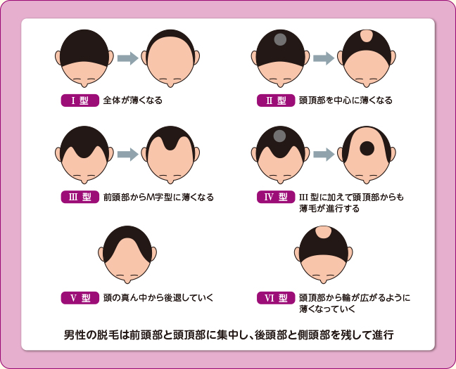 男性の壮年性脱毛症