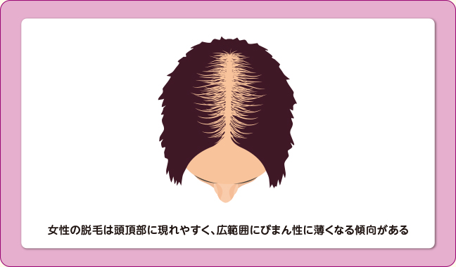 女性の壮年性脱毛症